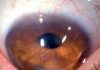 बार-बार आंख मसलने से हो सकता है किरेटोकोनस रोग