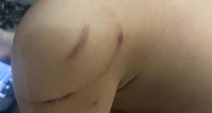 आवारा कुत्तों ने तीन साल के मासूम बालक को काटा